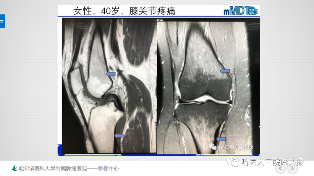 影像PPT - 【PPT】骨髓转化和再转化-52