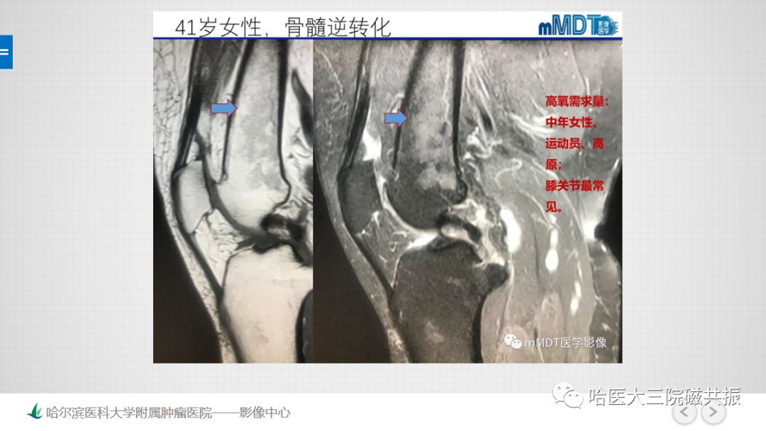 影像PPT - 【PPT】骨髓转化和再转化-53