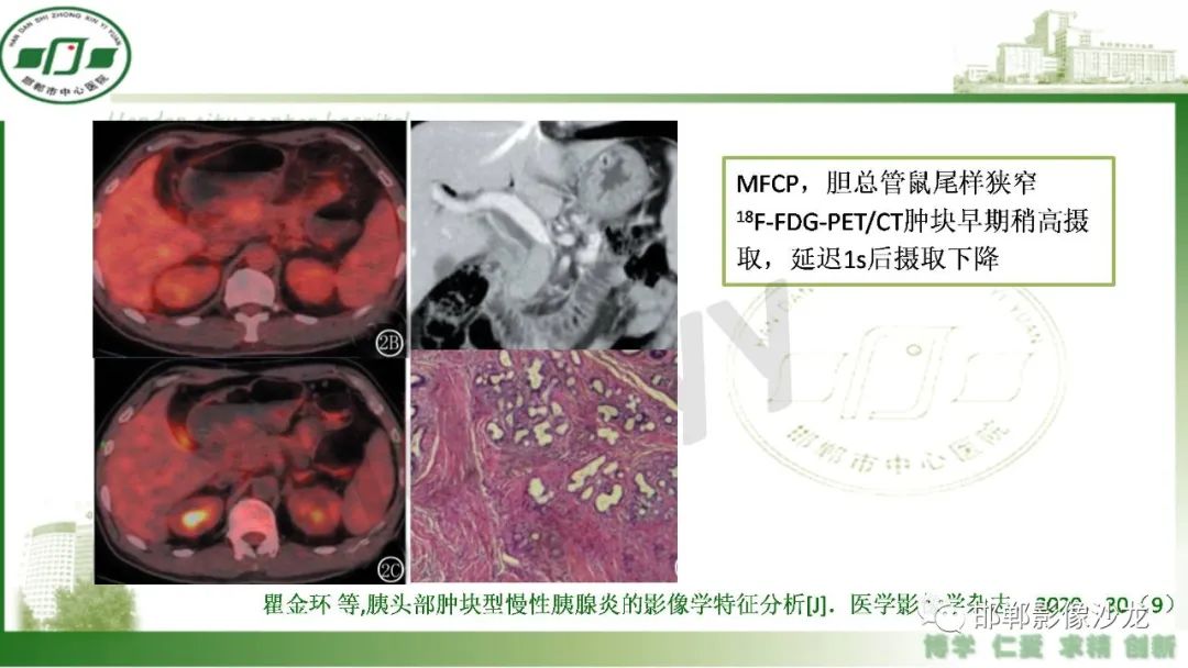 影像PPT - 【PPT】肿块性胰腺炎-10