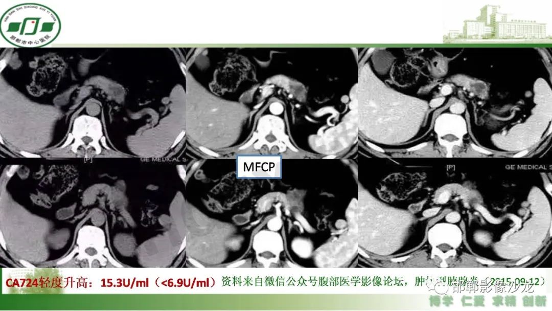 影像PPT - 【PPT】肿块性胰腺炎-12