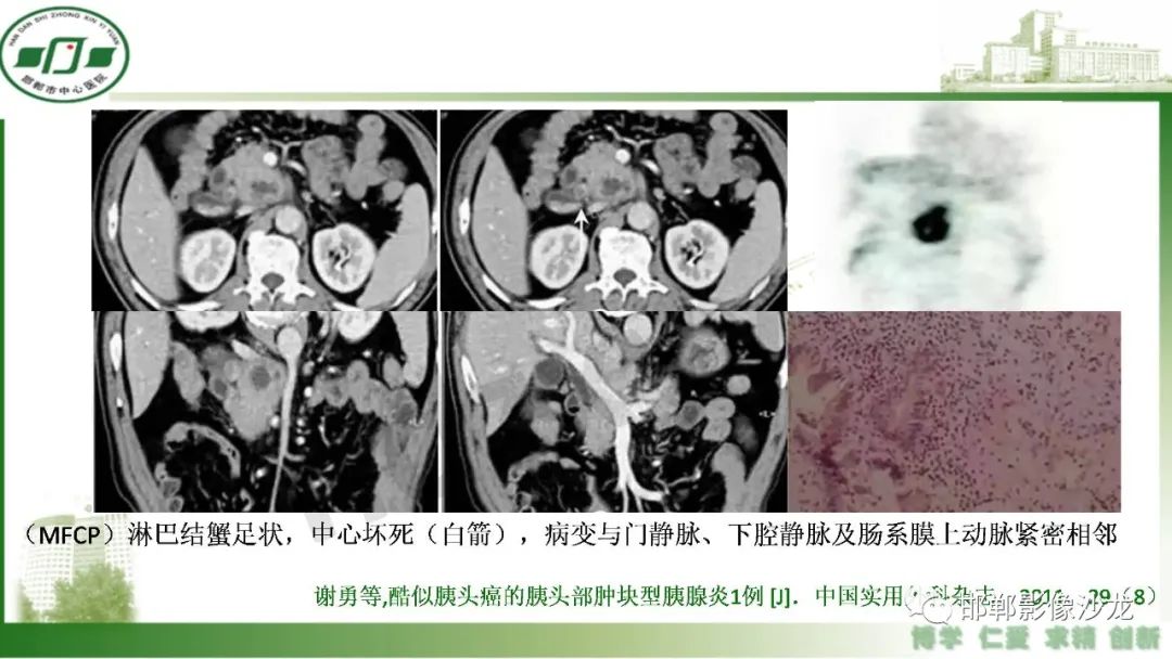 影像PPT - 【PPT】肿块性胰腺炎-11
