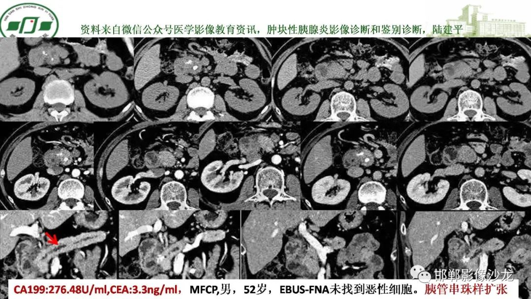 影像PPT - 【PPT】肿块性胰腺炎-13