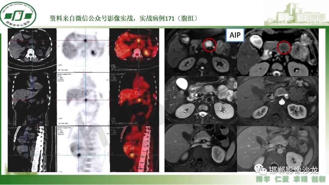 影像PPT - 【PPT】肿块性胰腺炎-18