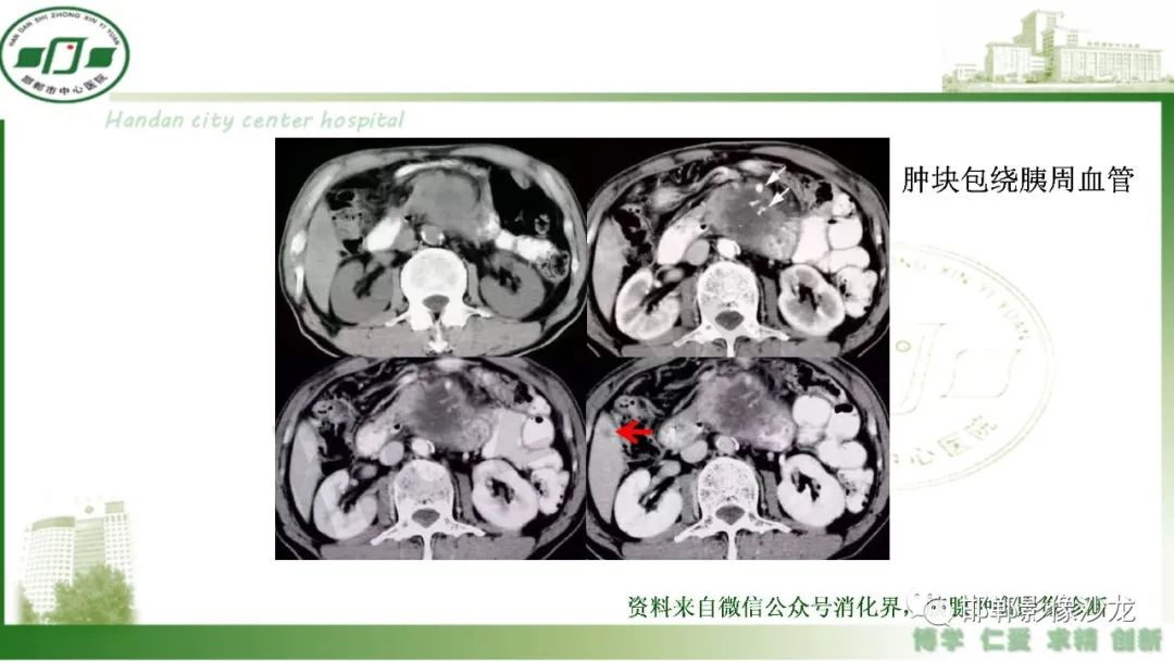 影像PPT - 【PPT】肿块性胰腺炎-27