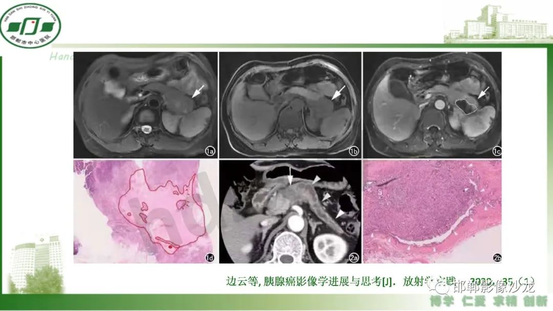 影像PPT - 【PPT】肿块性胰腺炎-28