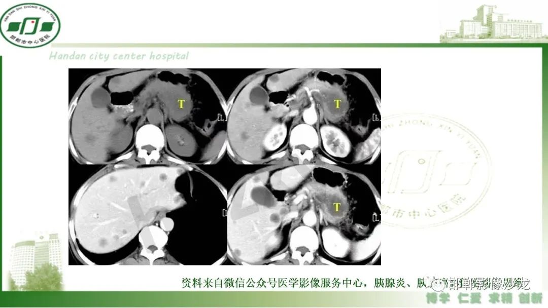 影像PPT - 【PPT】肿块性胰腺炎-29