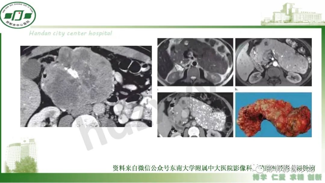 影像PPT - 【PPT】肿块性胰腺炎-33
