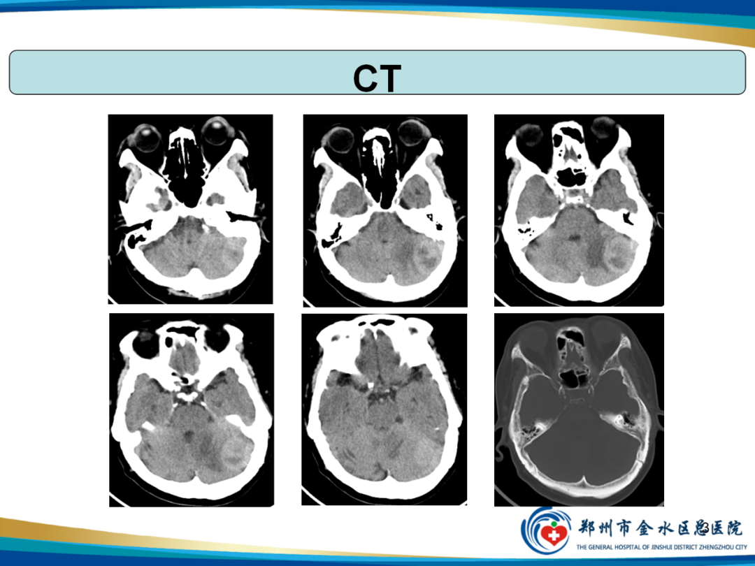 影像PPT - 【PPT】非典型脑膜瘤影像学诊断-3