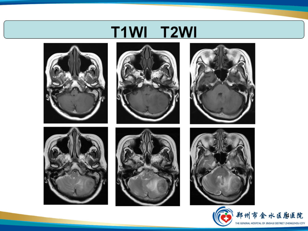 影像PPT - 【PPT】非典型脑膜瘤影像学诊断-4