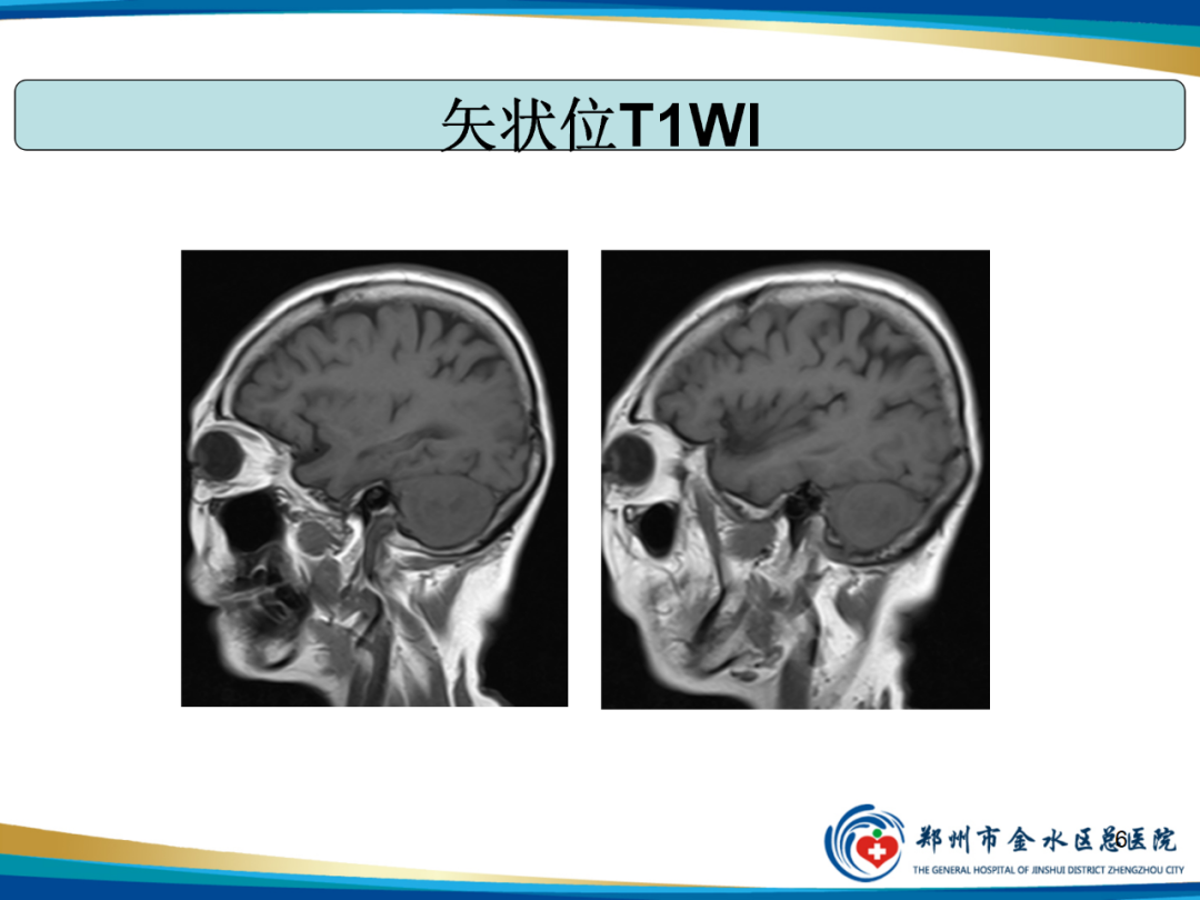 影像PPT - 【PPT】非典型脑膜瘤影像学诊断-6