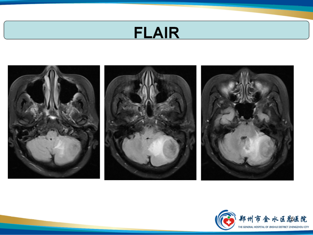 影像PPT - 【PPT】非典型脑膜瘤影像学诊断-5