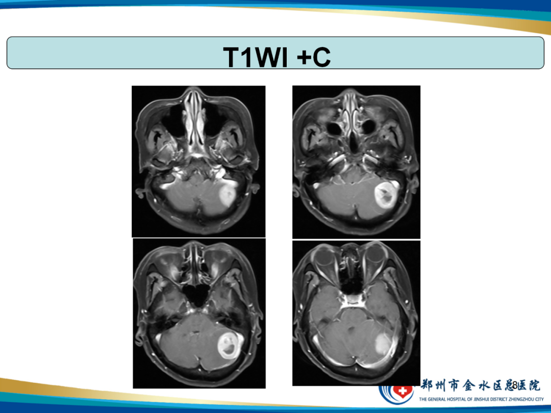 影像PPT - 【PPT】非典型脑膜瘤影像学诊断-8