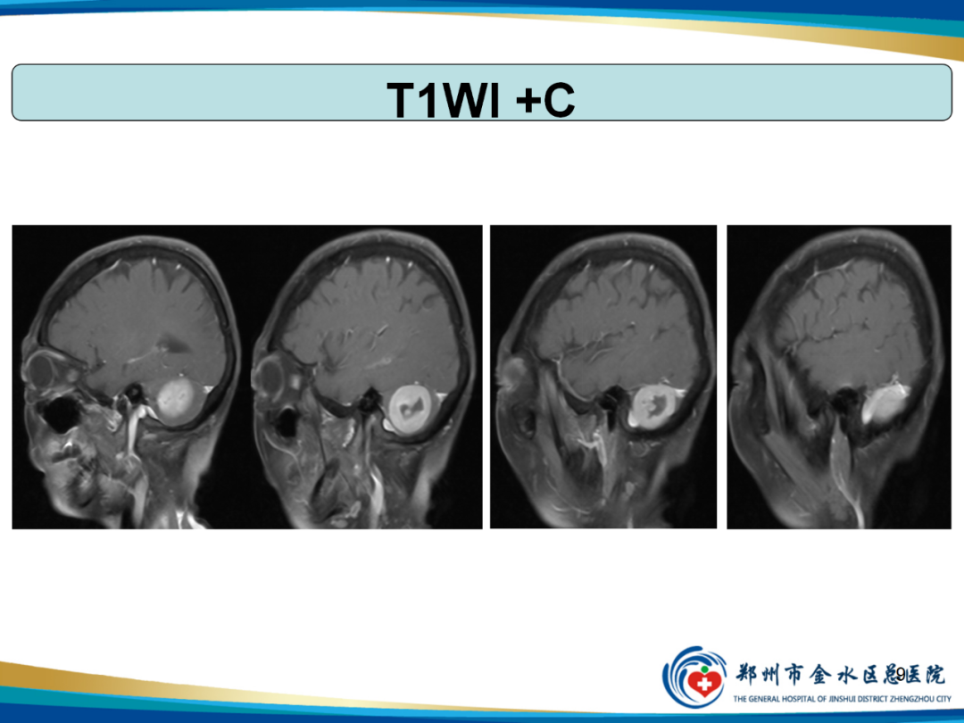 影像PPT - 【PPT】非典型脑膜瘤影像学诊断-9