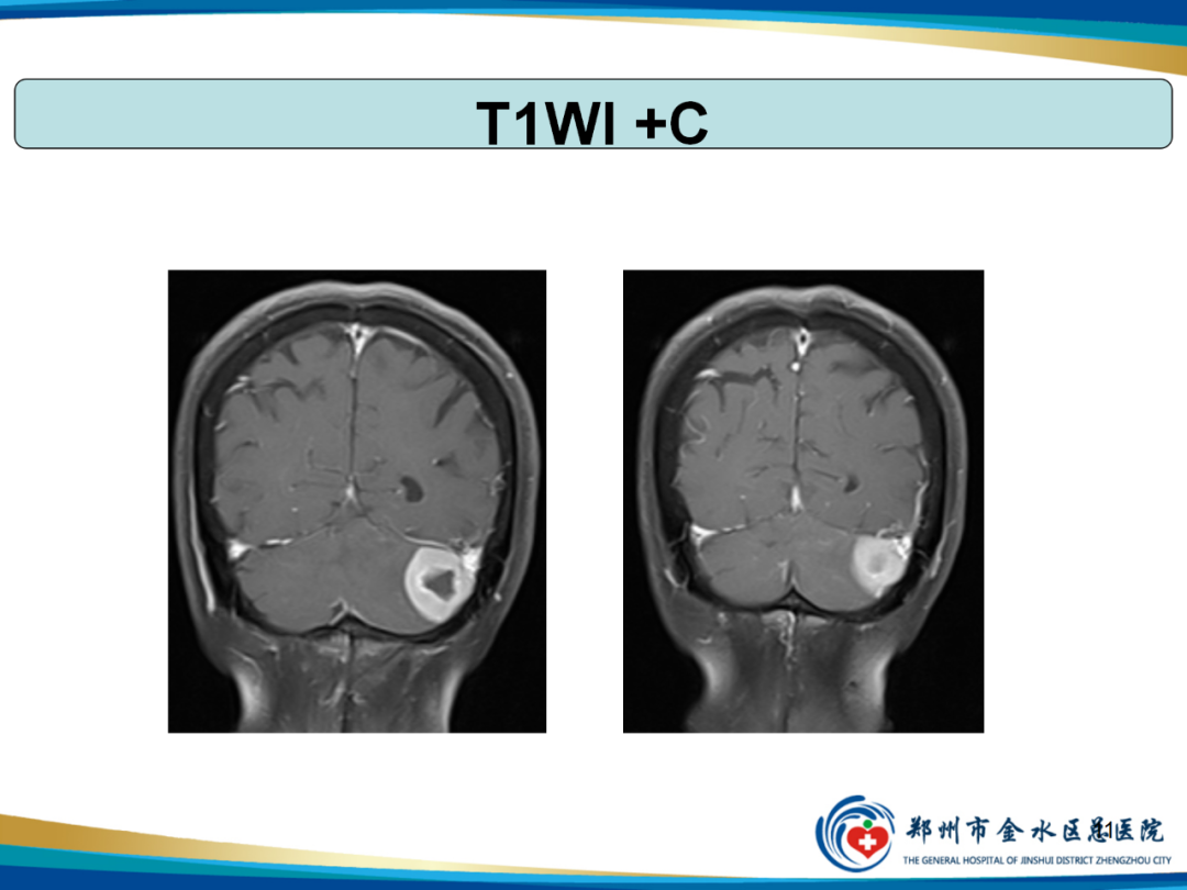 影像PPT - 【PPT】非典型脑膜瘤影像学诊断-11