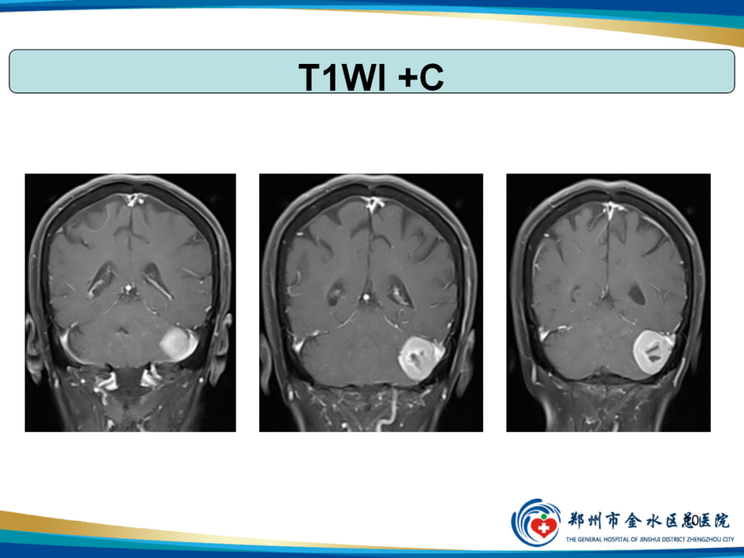 影像PPT - 【PPT】非典型脑膜瘤影像学诊断-10