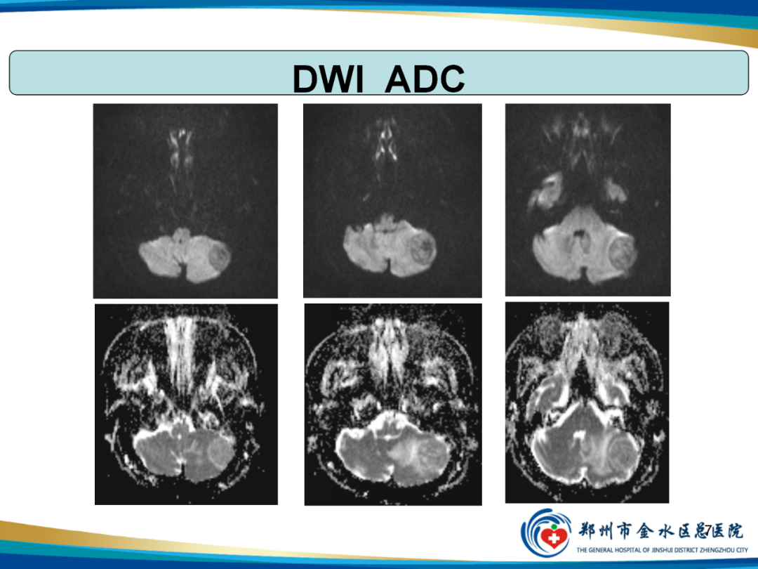 影像PPT - 【PPT】非典型脑膜瘤影像学诊断-7