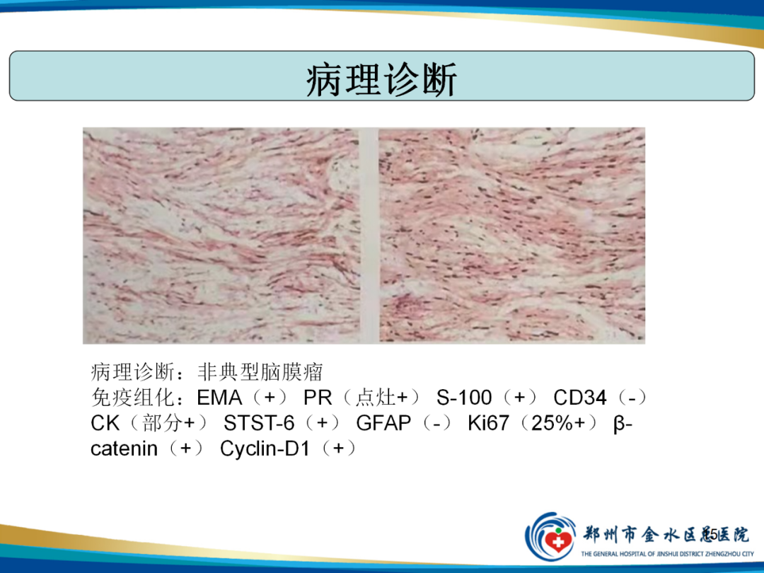 影像PPT - 【PPT】非典型脑膜瘤影像学诊断-15