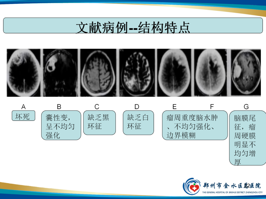 影像PPT - 【PPT】非典型脑膜瘤影像学诊断-22