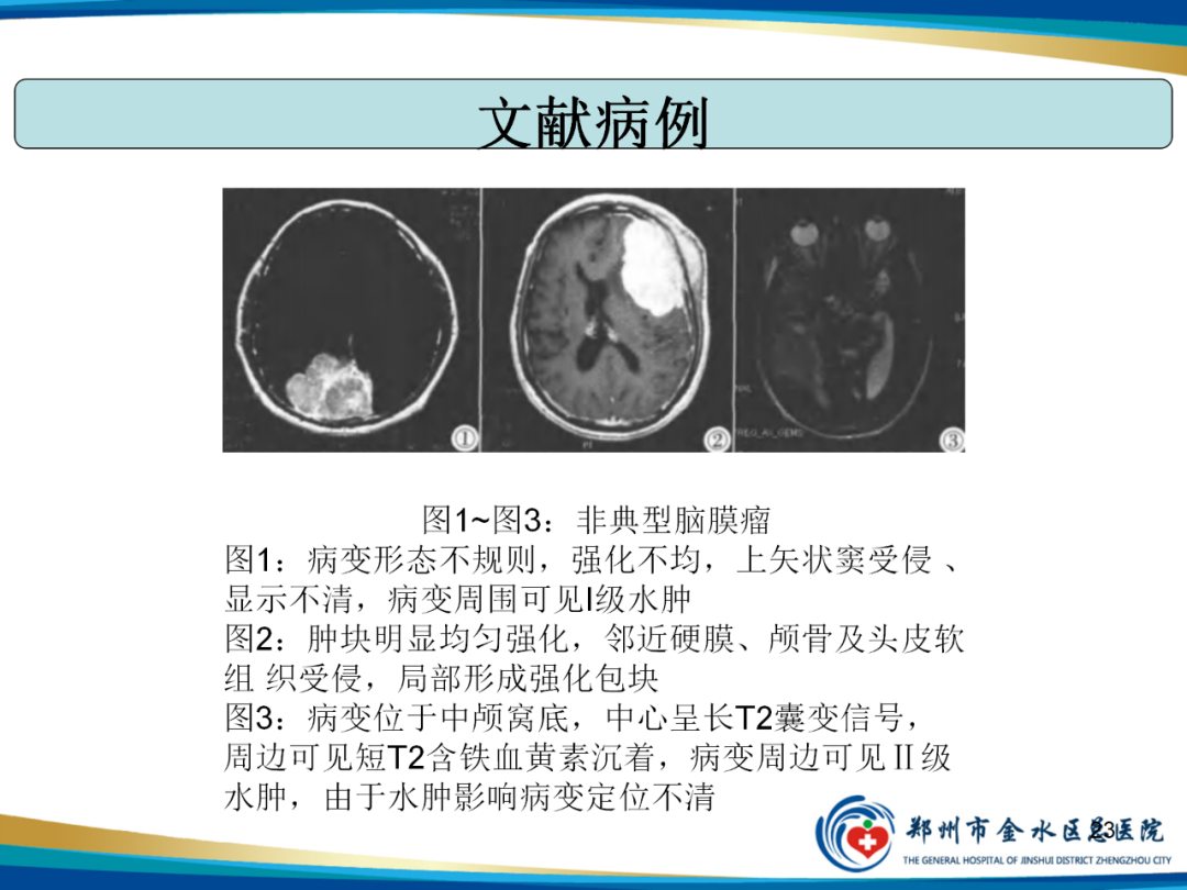 影像PPT - 【PPT】非典型脑膜瘤影像学诊断-23