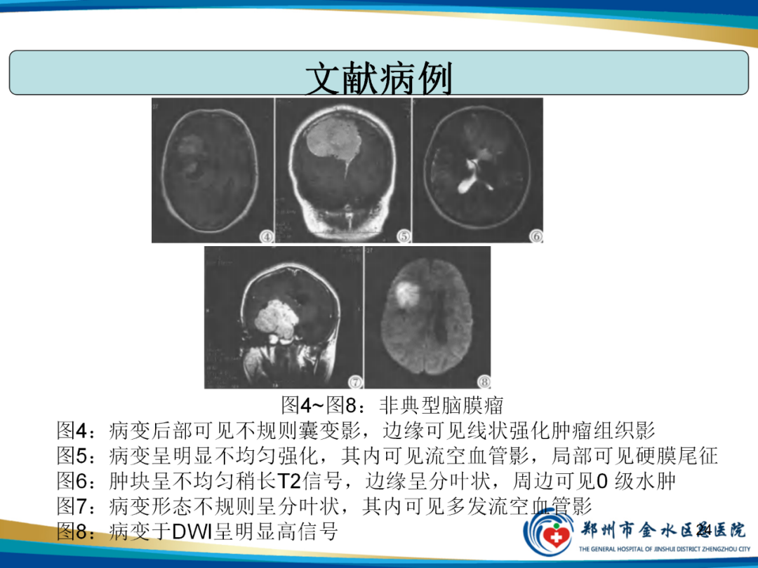 影像PPT - 【PPT】非典型脑膜瘤影像学诊断-24