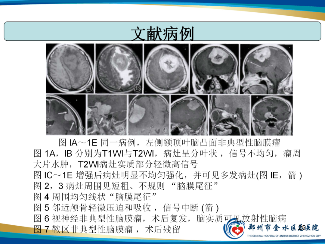 影像PPT - 【PPT】非典型脑膜瘤影像学诊断-25