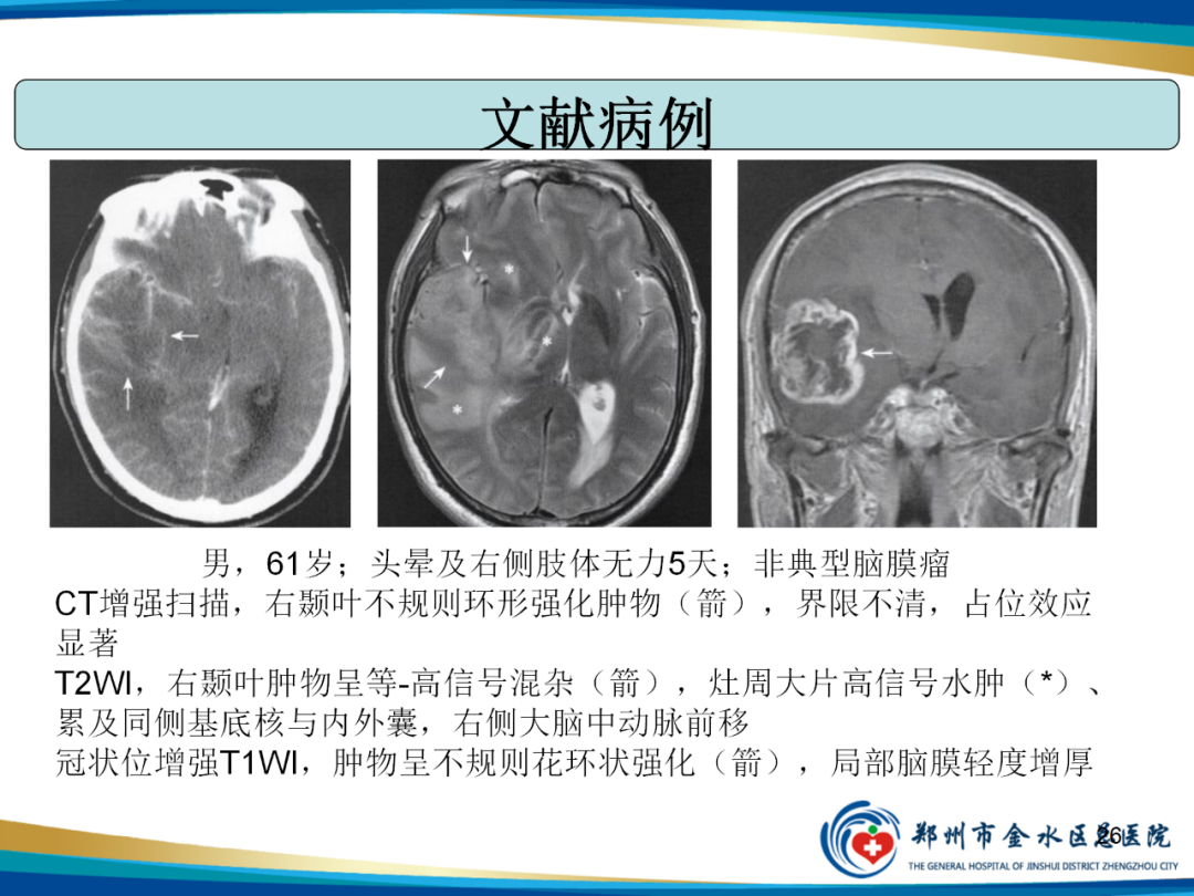 影像PPT - 【PPT】非典型脑膜瘤影像学诊断-26