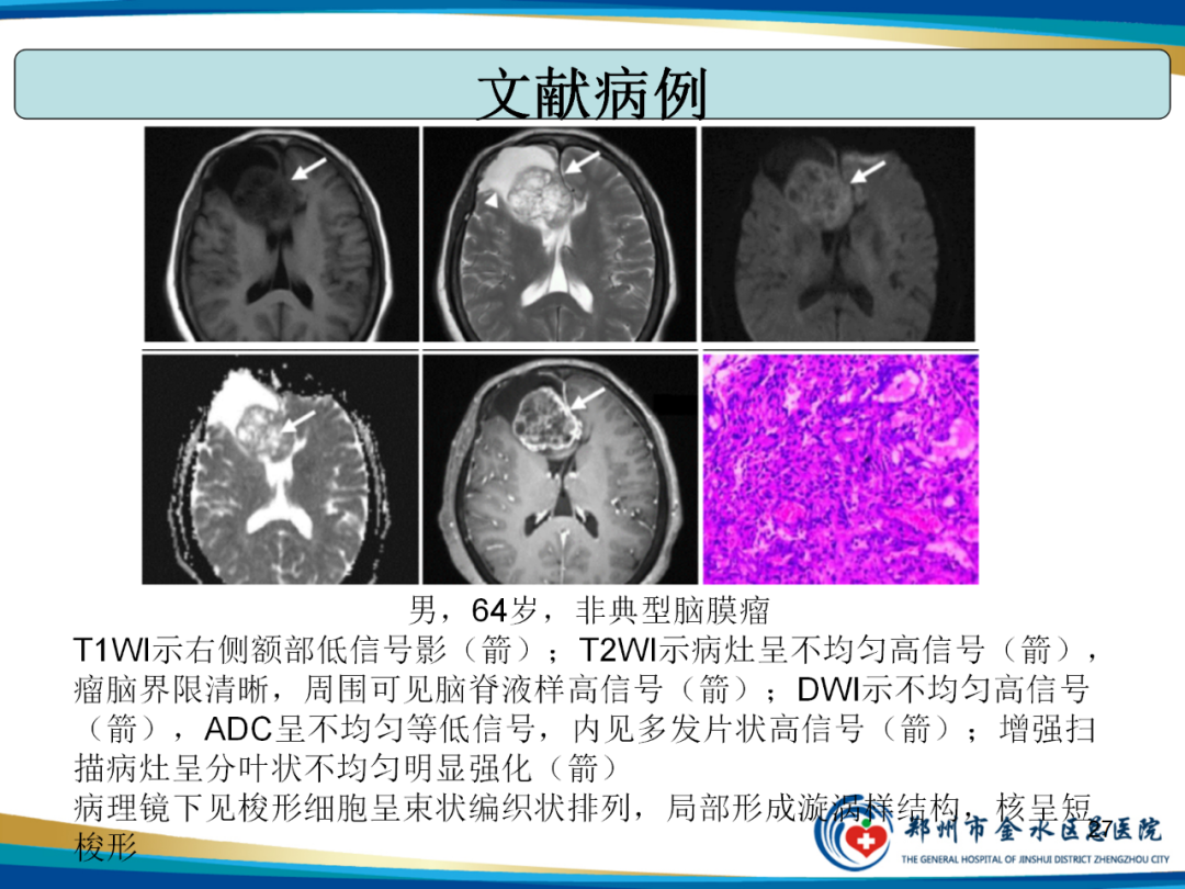 影像PPT - 【PPT】非典型脑膜瘤影像学诊断-27