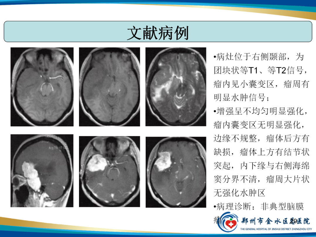 影像PPT - 【PPT】非典型脑膜瘤影像学诊断-29