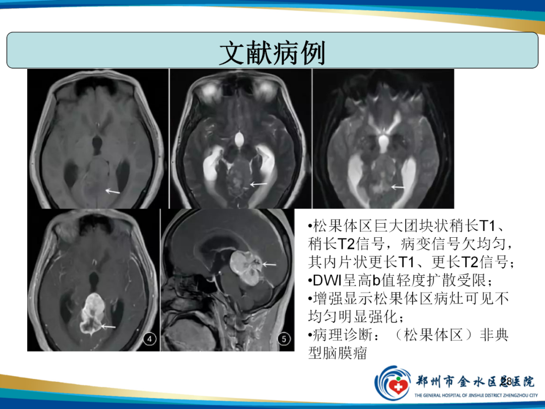 影像PPT - 【PPT】非典型脑膜瘤影像学诊断-28