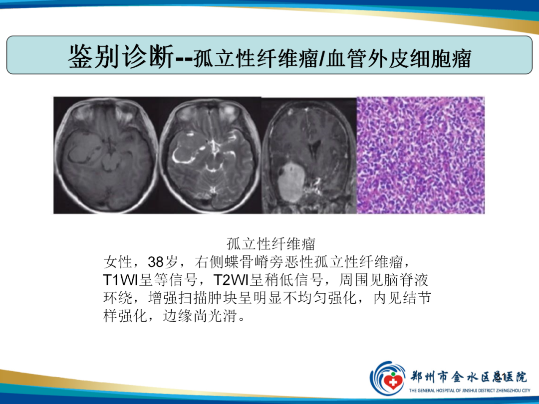 影像PPT - 【PPT】非典型脑膜瘤影像学诊断-31
