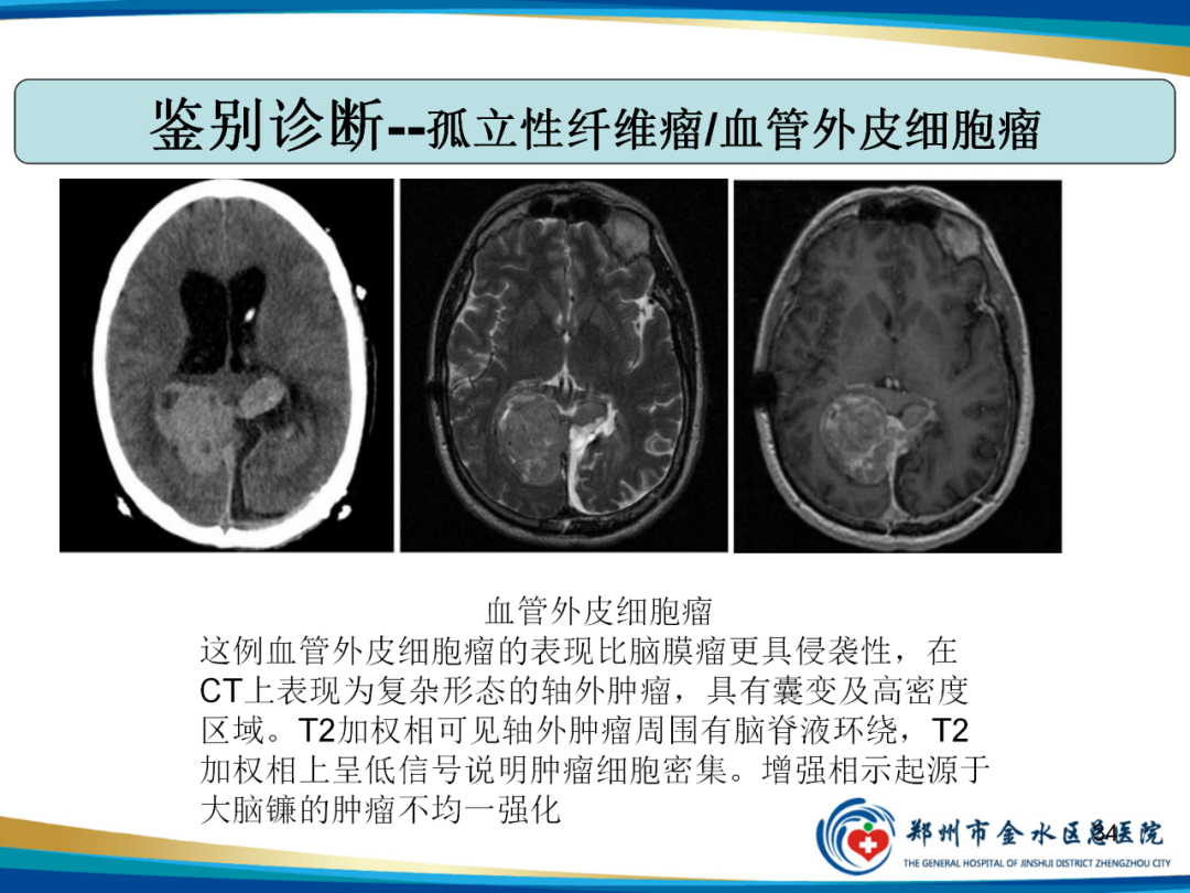 影像PPT - 【PPT】非典型脑膜瘤影像学诊断-34
