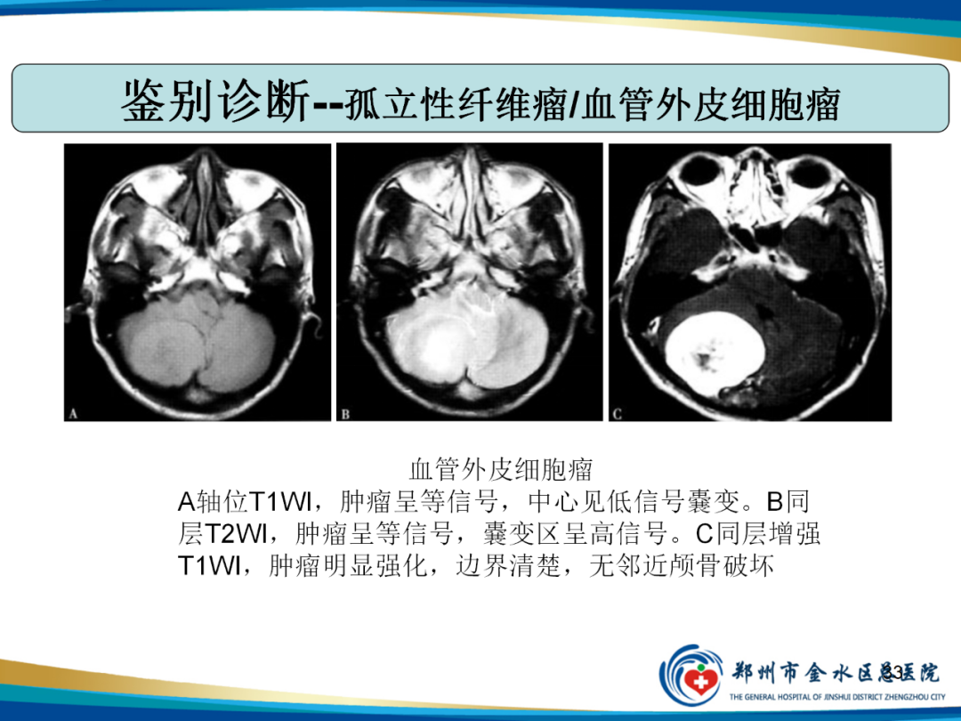影像PPT - 【PPT】非典型脑膜瘤影像学诊断-33