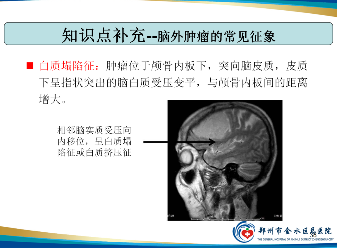 影像PPT - 【PPT】非典型脑膜瘤影像学诊断-38
