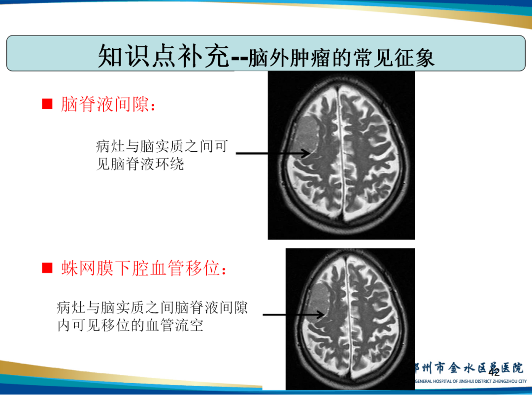 影像PPT - 【PPT】非典型脑膜瘤影像学诊断-42