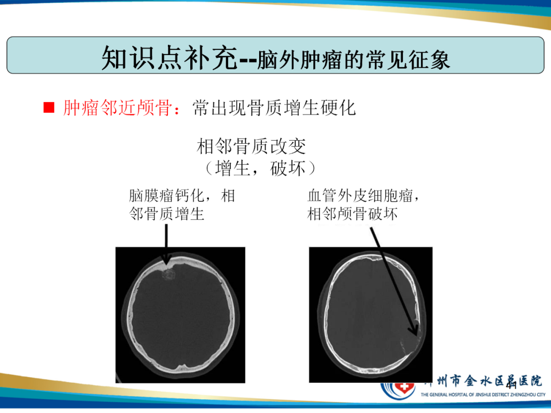 影像PPT - 【PPT】非典型脑膜瘤影像学诊断-41