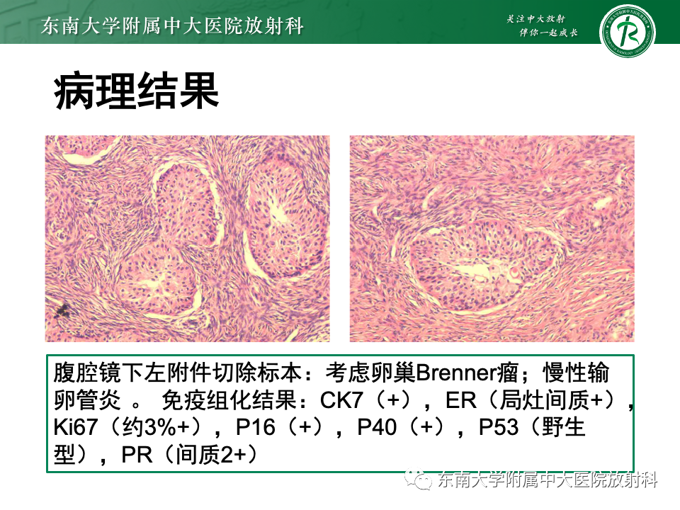 影像PPT - 【PPT】卵巢纤维上皮瘤(Brenner瘤)-8 影像PPT - 【PPT】卵巢纤维上皮瘤(Brenner瘤)-8