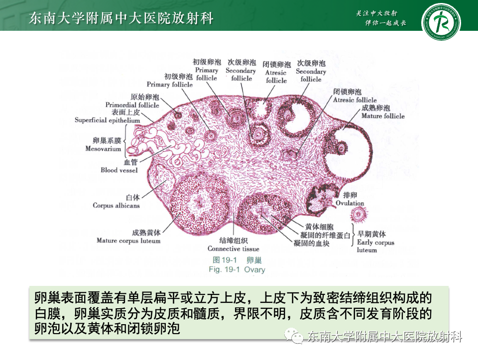 影像PPT - 【PPT】卵巢纤维上皮瘤(Brenner瘤)-11 影像PPT - 【PPT】卵巢纤维上皮瘤(Brenner瘤)-11