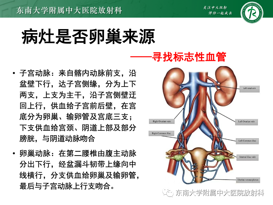 影像PPT - 【PPT】卵巢纤维上皮瘤(Brenner瘤)-12 影像PPT - 【PPT】卵巢纤维上皮瘤(Brenner瘤)-12