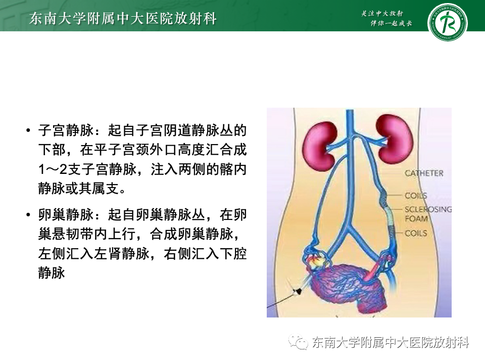 影像PPT - 【PPT】卵巢纤维上皮瘤(Brenner瘤)-13 影像PPT - 【PPT】卵巢纤维上皮瘤(Brenner瘤)-13