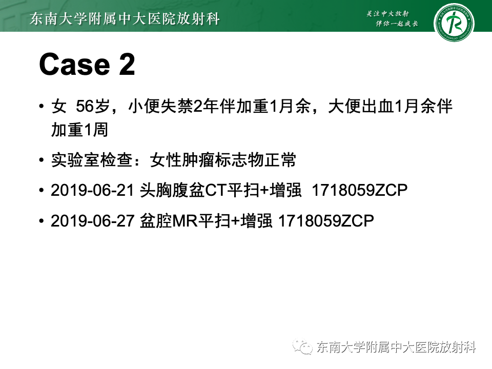 影像PPT - 【PPT】卵巢纤维上皮瘤(Brenner瘤)-18 影像PPT - 【PPT】卵巢纤维上皮瘤(Brenner瘤)-18
