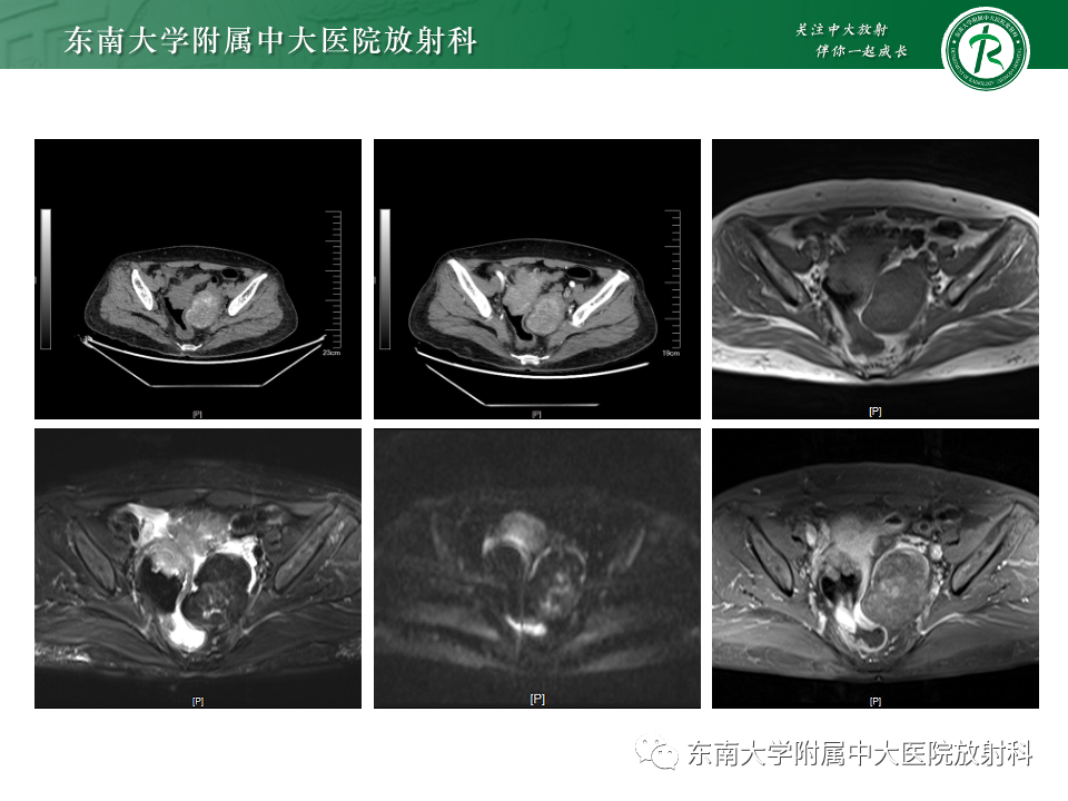 影像PPT - 【PPT】卵巢纤维上皮瘤(Brenner瘤)-19 影像PPT - 【PPT】卵巢纤维上皮瘤(Brenner瘤)-19
