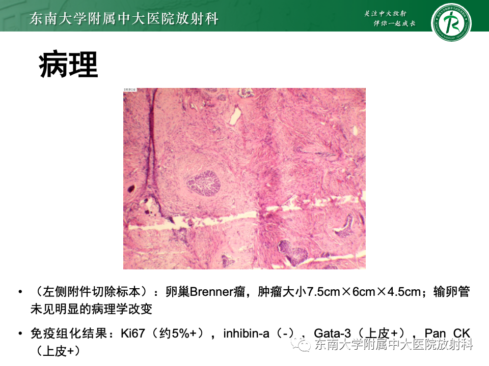 影像PPT - 【PPT】卵巢纤维上皮瘤(Brenner瘤)-20 影像PPT - 【PPT】卵巢纤维上皮瘤(Brenner瘤)-20