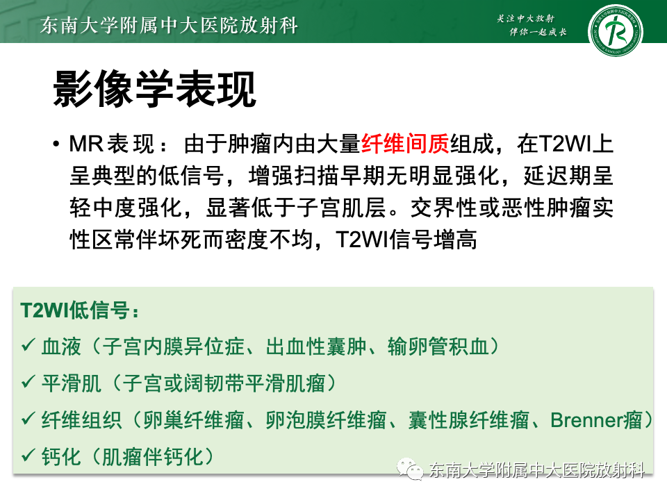 影像PPT - 【PPT】卵巢纤维上皮瘤(Brenner瘤)-21 影像PPT - 【PPT】卵巢纤维上皮瘤(Brenner瘤)-21