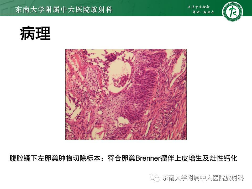 影像PPT - 【PPT】卵巢纤维上皮瘤(Brenner瘤)-24 影像PPT - 【PPT】卵巢纤维上皮瘤(Brenner瘤)-24
