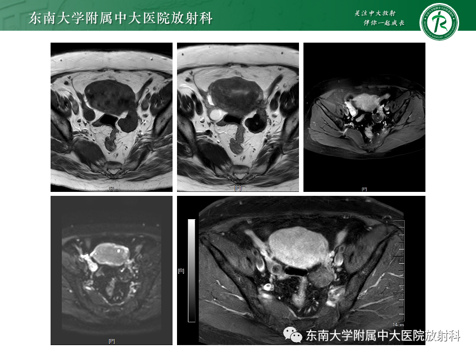 影像PPT - 【PPT】卵巢纤维上皮瘤(Brenner瘤)-27 影像PPT - 【PPT】卵巢纤维上皮瘤(Brenner瘤)-27
