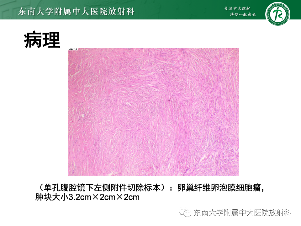 影像PPT - 【PPT】卵巢纤维上皮瘤(Brenner瘤)-28 影像PPT - 【PPT】卵巢纤维上皮瘤(Brenner瘤)-28