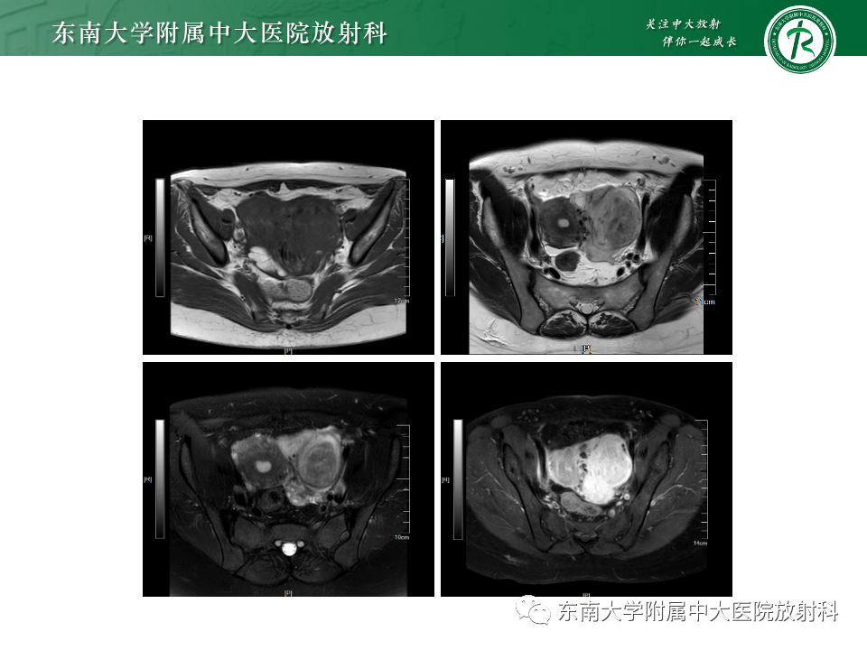 影像PPT - 【PPT】卵巢纤维上皮瘤(Brenner瘤)-33 影像PPT - 【PPT】卵巢纤维上皮瘤(Brenner瘤)-33