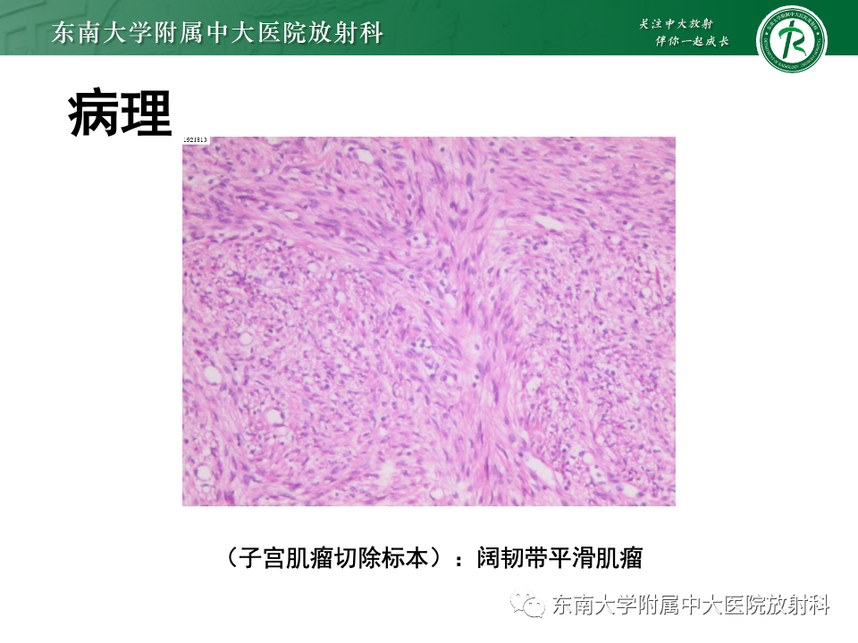 影像PPT - 【PPT】卵巢纤维上皮瘤(Brenner瘤)-34 影像PPT - 【PPT】卵巢纤维上皮瘤(Brenner瘤)-34
