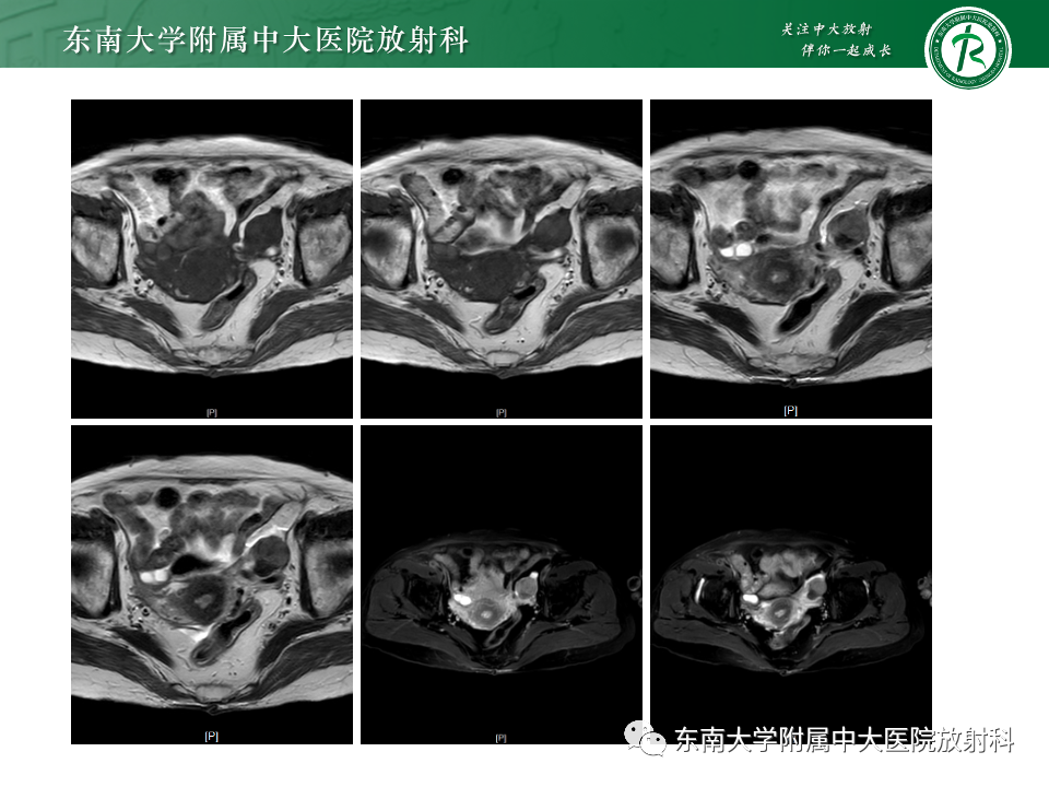 影像PPT - 【PPT】卵巢纤维上皮瘤(Brenner瘤)-3 影像PPT - 【PPT】卵巢纤维上皮瘤(Brenner瘤)-3