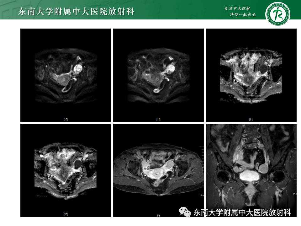 影像PPT - 【PPT】卵巢纤维上皮瘤(Brenner瘤)-4 影像PPT - 【PPT】卵巢纤维上皮瘤(Brenner瘤)-4